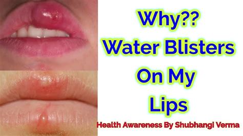 why water blisters on my lips home remedy for water blisters on lips youtube