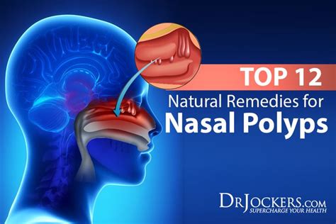 Nasal Polyps Symptoms Causes And Natural Support Strategies Chest
