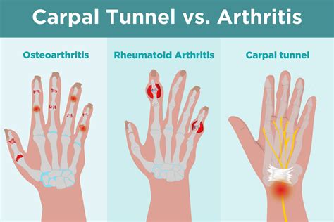 Carpal Tunnel Syndrome Vs Arthritis Whats The Difference