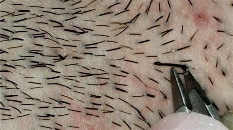 Plucking Thick Beard Hairs Gross And Satisfying Youtube