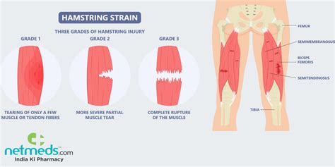 Hamstring Injury Causes Symptoms And Treatment