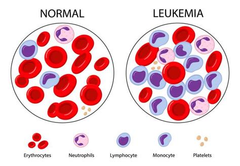 Leukemia Disease Types Sign Symptoms And Causes