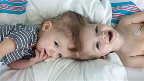 10 Truly Unbelievable Kids Living With The Rarest Medical Conditions