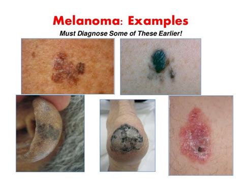 Skin Cancer A Curable Disease 2016