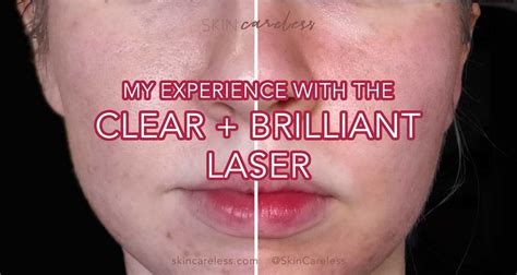 I Got Clear Brilliant Laser My Experience And Results Skin Careless