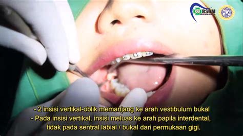 Mengenal Abses Gigi Dari Skill Lab Penatalaksanaan Bedah Mulut Minor Dental Medicine Faculty