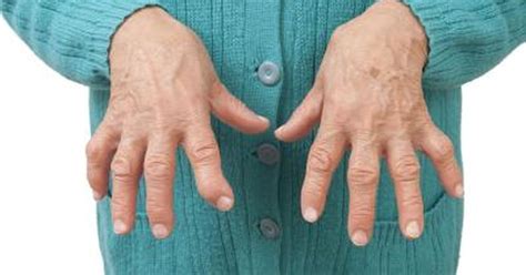 Symptoms Of Lupus Vs Rheumatoid Arthritis Livestrongcom