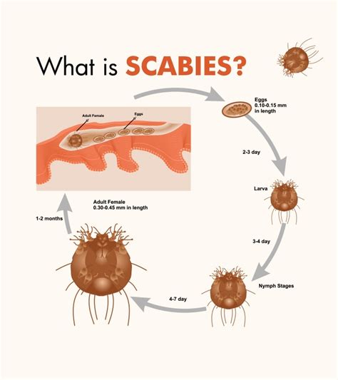scabies causes symptoms and treatment youtube