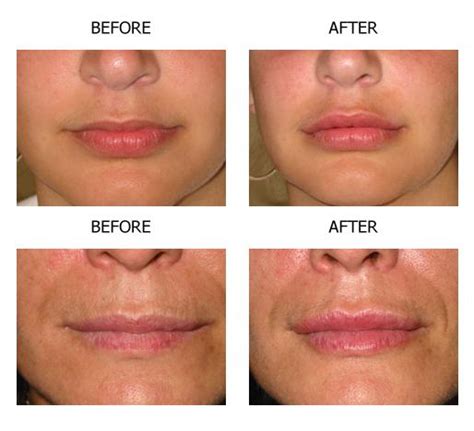 Permanent Lip Augmentation Before And After Photos And Cost