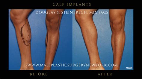 Calf Implants Surgery For Men Male Plastic Surgerymale Plastic Surgery