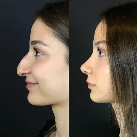 The Results Of A Rhinoplasty Awesome Pretty Nose Nose Surgery