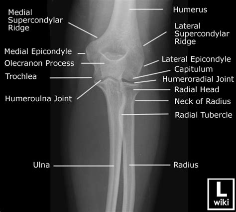 Labeled Elbow Xray Anatomy Ap View Anatomy Radiology Grepmed