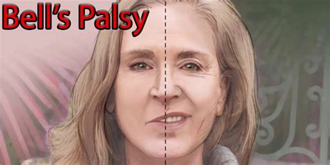 Bells Palsy Legacy Spine And Neurological Specialists