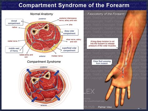 Compartment Syndrome Of The Forearm Trial Exhibits Inc