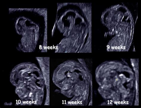 Neurosonoembryology By Three Dimensional Ultrasound Seminars In Fetal