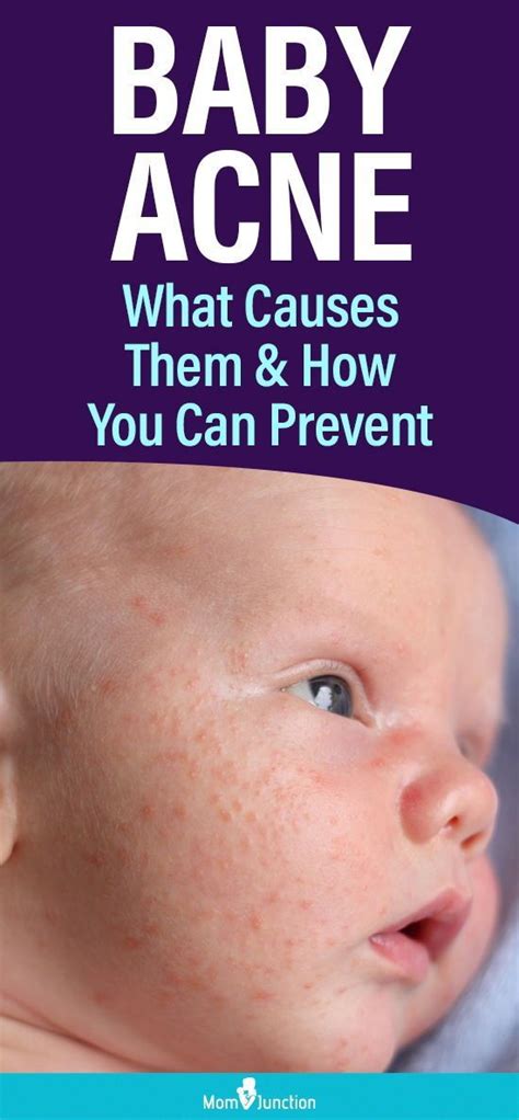 Baby Acne What Causes Them And How You Can Prevent In 2021 Baby Acne