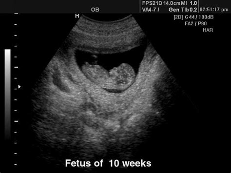 Ultrasound Images • Fetus 10 Weeks B Mode Echogramm №118