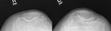 Not A Typical Case Of Bilateral Knee Osteoarthritis The Bmj