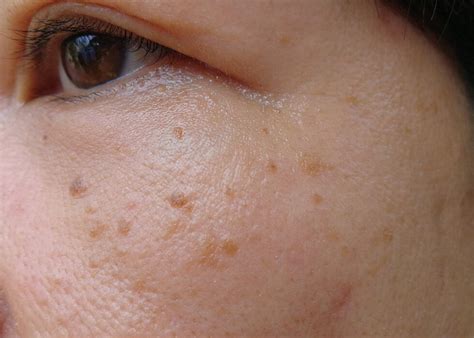 Seborrheic Keratosis Causes Treatments Dermatology Inc