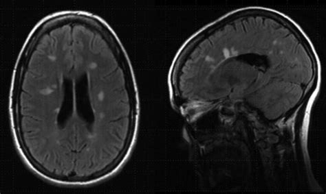 White Matter Lesions On Magnetic Resonance Imaging Neupsy Key