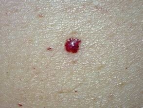Here you can see multiple reddish to purplish spots (papules) on trunk, these are actually cherry angioma and are also known as campbell de morgan spots. Cherry angioma images | DermNet NZ