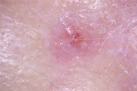 0 Result Images Of White Spots On Skin Cancer Png Image Collection