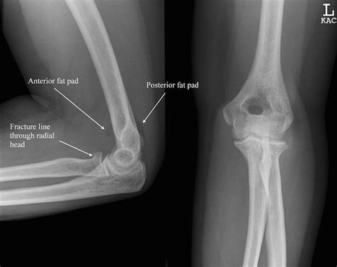 Radial Head Fractures Ace Physical Therapy And Sports Medicine Institute