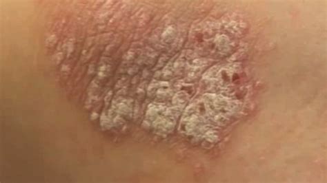 Collection Of Dark Scaly Spots On Skin 15 Signs That
