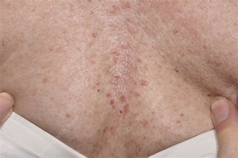 Folliculitis Of The Chest Stock Image C0498184 Science Photo Library