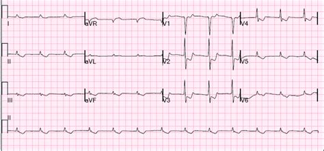 Dr Smiths Ecg Blog Looks Like A Posterior Stemi Is It