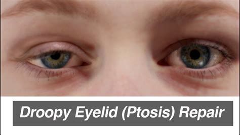 Droopy Eyelid Ptosis Repair Youtube