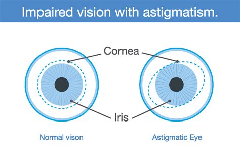 Astigmatism Causes Blurred Vision First Eye Care Downtown Dallas