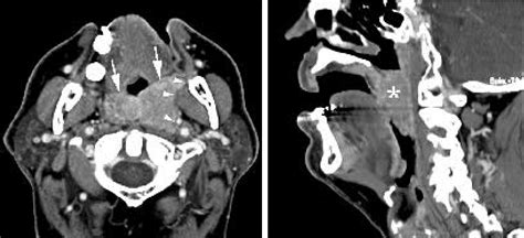 Figure 3 Contrast Enhanced Ct Images In A Patient With Soft Palate