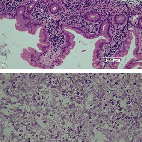 Pdf A Case Report Of The Histologic Transformation Of Primary