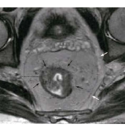 Mri Of Rectal Cancer With Demonstration Of Circumferential Resection