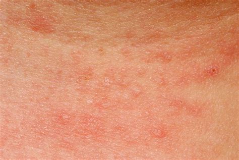 Allergy And Skin What To Do The Types And Causes Skin Allergies