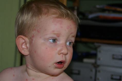 Chicken Pox Symptoms How To Diagnose And Treat Immediately