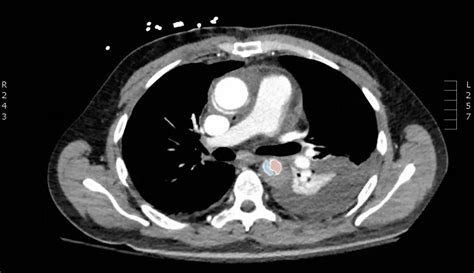 Acute Aortic Dissection Presenting Exclusively As Lower Extremity