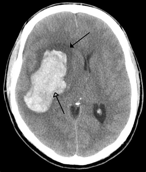 Stroke Ct Scan Wikidoc