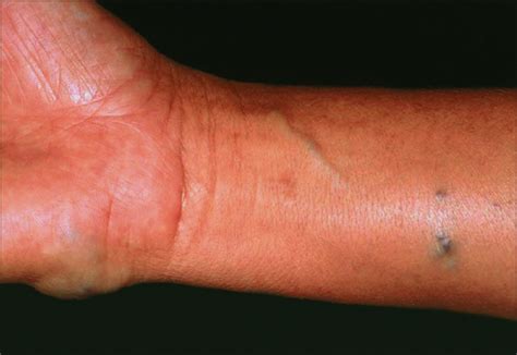 Bluish Nodules On The Trunk And Arms—case Dermatology Jama