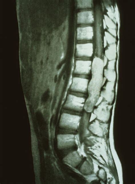 Tumor Spinal Cord Sacral Region Mri Image My Xxx Hot Girl