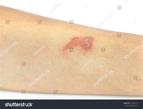 Raised Red Bumps Blisters Caused By Stock Photo 351482117 Shutterstock