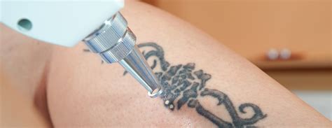 Easy And Safe Tattoo Removal