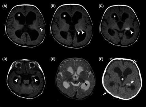 Mr And Ct Scan Of Our 10‐month‐old Patient With Neurocutaneous
