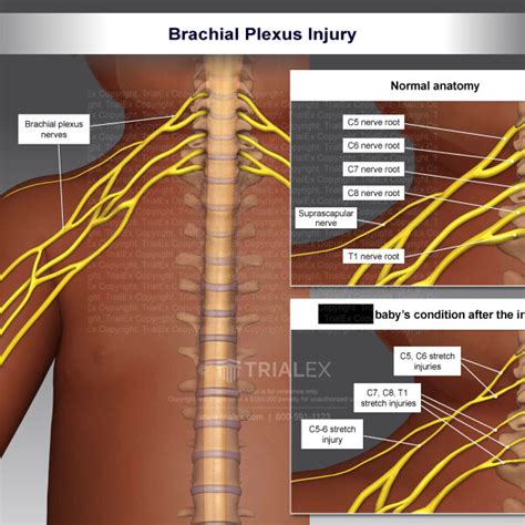 Brachial Plexus Injury Trialexhibits Inc