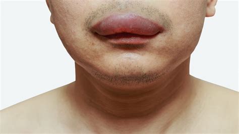 swollen upper lip causes symptoms sudden and top lip swelling treatments american celiac