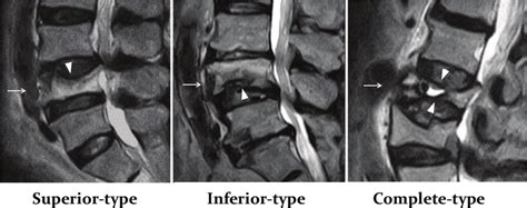 Preoperative Mri Images Showing The Three Types Of Burst Fracture