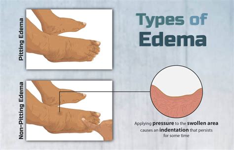 What Is Edema Types Symptoms And Causes