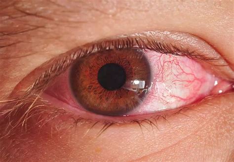 Why Is Pink Eye More Common In Winter