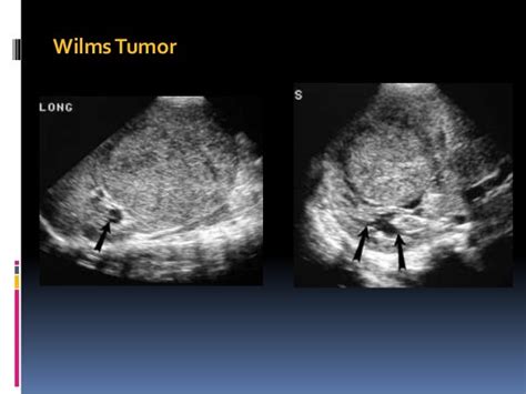 Pediatric Renal Tumors Radiology